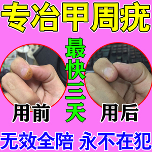 甲周疣专用药膏治甲下疣祛肉刺瘊子去除膏扁平疣手足跖疣去除神器