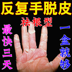 手脱皮的药修复霜