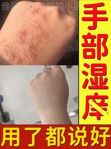 宝宝湿痒疹苗族独方止痒王癣药膏云南本草止痒灵皮毒清软膏百廯膏