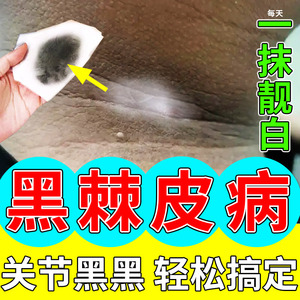 黑棘皮病药膏告治别脖子后面黑黑的黑棘皮症去除去黝黑黑色素沉淀