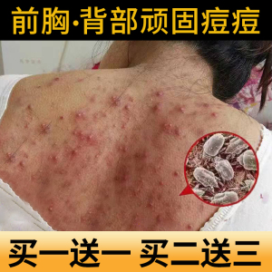 除螨沐浴露祛痘后背祛螨前胸背上长痘痘去背部痘痘螨虫深层清洁