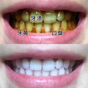 【好物推荐】告别大黄牙 牙齿去黄变白神器 烟渍茶牙克星洁牙慕斯