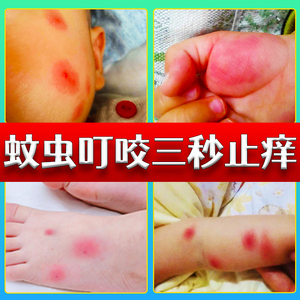 蚊虫叮咬止痒消削肿药膏婴儿专用宝宝儿童防跳蚤咬鼓包驱蚊膏喷雾