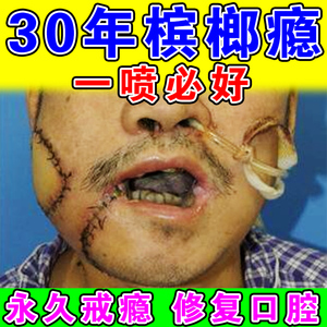 戒槟榔神器口腔粘膜纤维化修复张嘴困难牙齿变黑牙龈萎缩专用喷剂