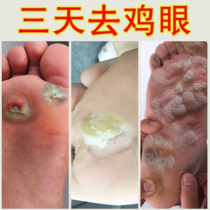 偏方刺猴去除正品鸦胆子丝状疣跖疣中药无痕尖锐湿疣足底脚去鸡眼