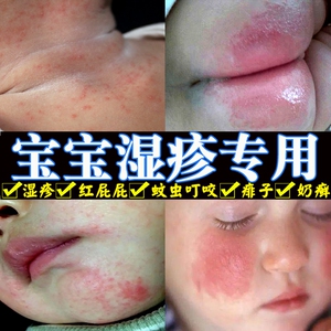 宝宝婴儿湿疹膏儿童脸部抑菌皮肤病头皮霜顽固性皮疹幼儿百草药膏