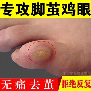 鸡茧净修鸡眼工具祛鸡眼去除脚底急眼脚上长鸡眼几眼脚垫贴膏脚趾