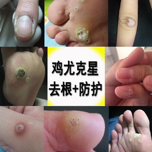 去猴子肉刺膏脚底