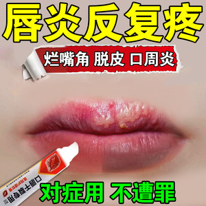 唇炎专用口周皮炎药膏口角炎烂嘴角疱疹润唇药膏嘴唇干裂脱皮修复
