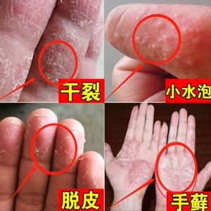 擦草本药膏专治鹅掌风药膏手藓药膏真菌感染烂手手掌脱皮药膏本草