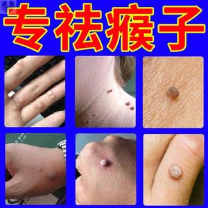 瘊子去除神器祛猴子手足跖疣丝状尤皮赘脖子长小肉粒疙瘩肉痣抑菌
