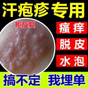 汗疱疹汗状孢疹汗脚上手指上痒起小水泡专治干裂脱皮止痒专用药膏