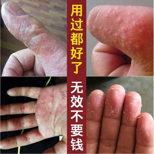 手脱皮爆皮手蜕皮修复霜手指掉皮治手掌心起水泡开裂干裂退皮药膏