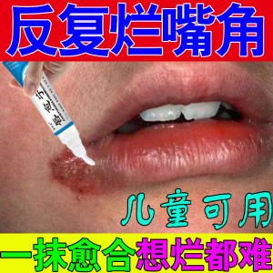 口角炎药膏烂嘴角单双侧发炎红肿疼痛起泡口角溃烂男女通用止疼膏
