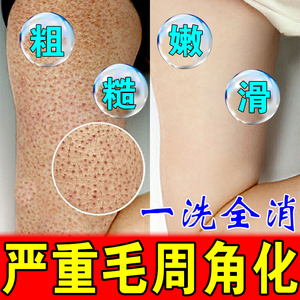 毛周角化症脸堵塞疏通毛囊药身体乳去鸡皮肤疙瘩马拉色菌沐浴露膏