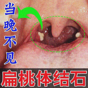 扁桃体结石漱口水去除工具去口臭结石吸取器去除工具抑菌消毒口腔
