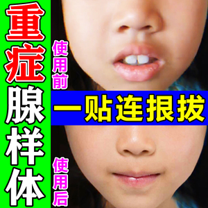 【包冶】儿童腺样体肥大面容矫正器鼻塞呼噜嘴呼吸中药调理保健贴