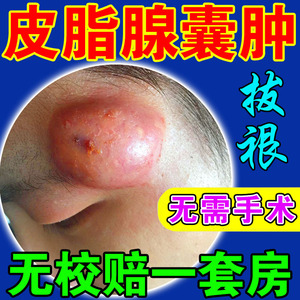皮脂腺囊肿膏火疖子拔毒拔脓神器去除皮下囊肿痘痘粉瘤痤疮药膏
