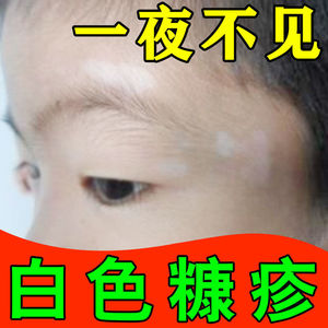 【买一送一】儿童成人白色糠疹脸上白斑长鳞屑单纯糠疹虫斑