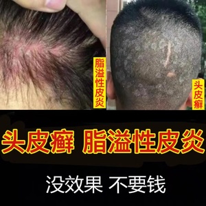 脂溢性皮炎去根除头皮癣头癣头皮屑头部面部外用软膏专用药膏