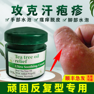 汗泡汗疱疹手气手上起小水泡专用药膏汗孢疹手痒汗状止痒进口软膏