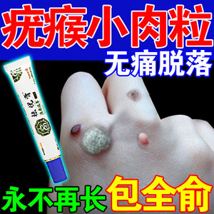 肉刺瘊子祛疣灵扁平优药膏趾疣去指甲发厚变黄根神器甲周疣专用药