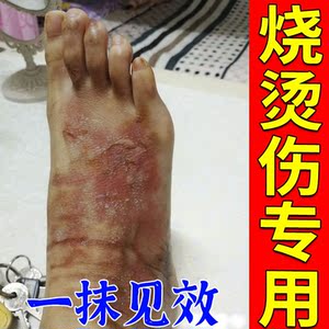 烫伤特效药遮烫伤疤神器开水油烧伤烫伤膏正品去疤修复止疼止痒膏