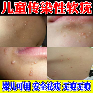 儿童传染性软疣儿童大人宝宝病毒性软疣水猴子软尤水瘊子膏