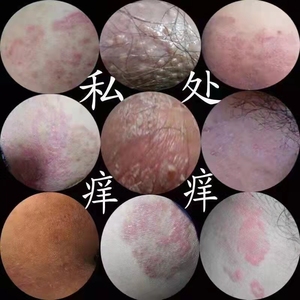 ww745128135w淘宝皮肤大腿内侧毛囊炎阴毛痒长痘痘外阴瘙痒止痒膏女