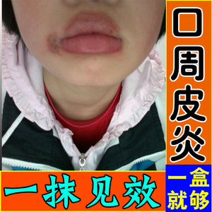 儿童专用口周皮炎舔嘴唇周围红肿干裂起皮水泡发痒医用护理软膏药