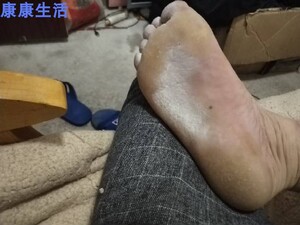 脚底板发白褶皱脚气老郎中药膏复方黄柏祛癣搽剂治疗牛皮癣银屑病