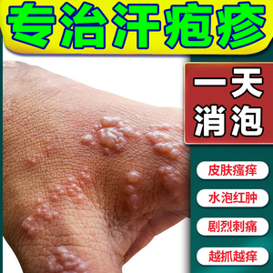 治汗状疱疹专用止痒软膏手上小水泡手痒起泡脱皮干裂瘙痒专用药膏