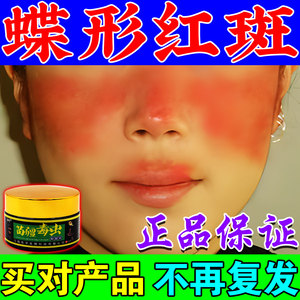 系统性红斑狼疮盘状蝶形红斑面部呈淡红色鲜红色蝴蝶型红斑专用药
