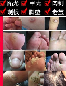 治疗成人扁平疣手脚脖子瘊子刺肉脚底老茧克星去除鱼鳞痣鸡眼药膏