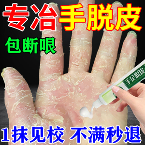 剥脱性角质松懈症治疗手脱皮严重脱皮专用的药膏手上起皮干燥脱皮