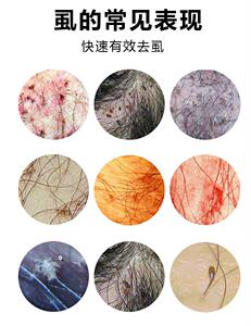 治儿童小女孩头上的虱子卵头发防跳蚤喷雾去阴虱专用方圆方圆50018