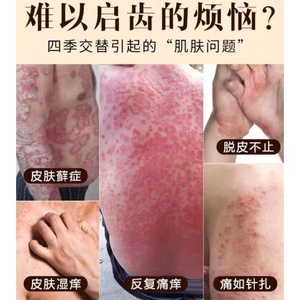 三珍清外用喷剂癣根除药膏治手脚脱皮起小水泡湿疹汗疱疹紫椒癣酊