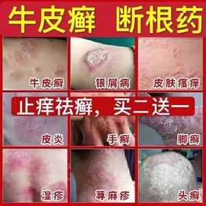 牛皮藓银屑病癣股癣手足头皮癣疹湿止痒去根皮肤专用疗治特效药膏