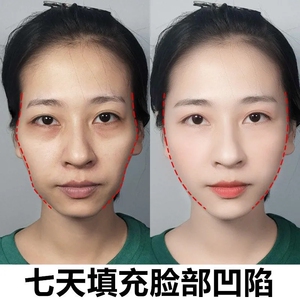 【华北制药】丰太阳穴脸部凹陷眼窝额头饱满法令纹泪沟填充神器