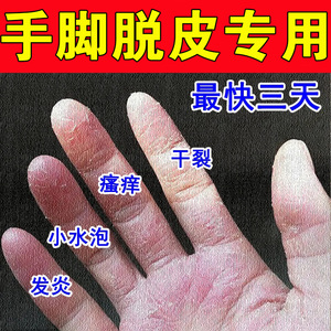 00tb332562104淘宝治疗鹅掌风湿疹手部手气膏真菌感染手上手足藓蜕
