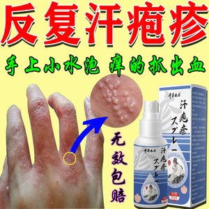 汗疱疹药膏手上小水泡专用喷剂脱皮鹅掌风干裂脱皮手癣膏真菌感染
