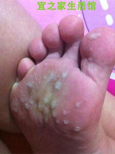 脚板心痒脚气千草苗方地椒草抑菌药膏16克/支江西诚源生物 包邮买