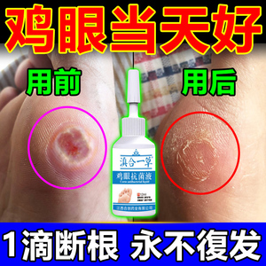 去鸡眼神器脚趾