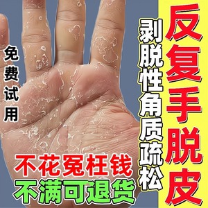 剥脱性角质松懈症治疗手脱皮的药膏季节性手上起皮干燥脱皮修复霜