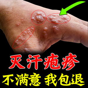 汗疱疹药膏手上痒起小水泡治汗泡疹鹅掌风手足癣干裂脱皮特效止痒