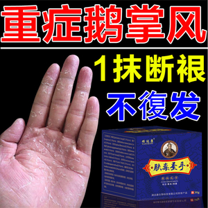 鹅掌风干裂脱皮止痒抑菌膏手足藓药真菌感染烂手肤毒瘙痒疱疹特效