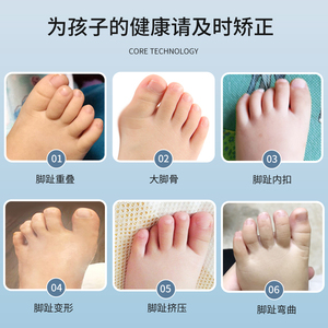宝宝婴儿脚趾矫正器儿童专用重叠纠正神器拇指外翻小孩幼儿分趾器