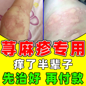 日本进口荨麻疹过敏止痒断裉根专用药急慢性风团荨麻疹皮肤瘙痒膏