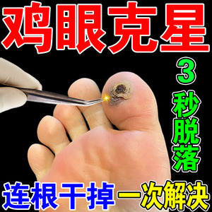 治疗脚鸡眼