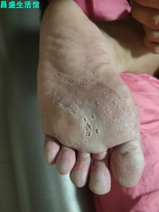 脚底板发白脚气济生堂何药师蜂毒换皮素抑菌药膏18g皮肤外用软膏